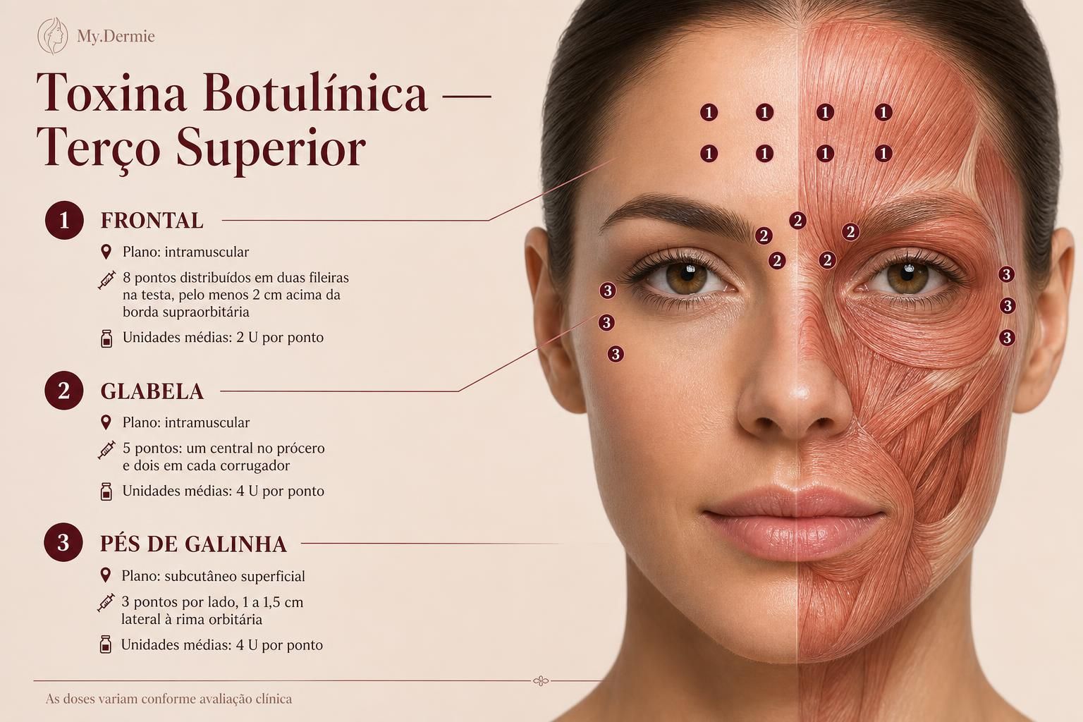 Prancha de pontos de aplicação de toxina botulínica no terço superior da face